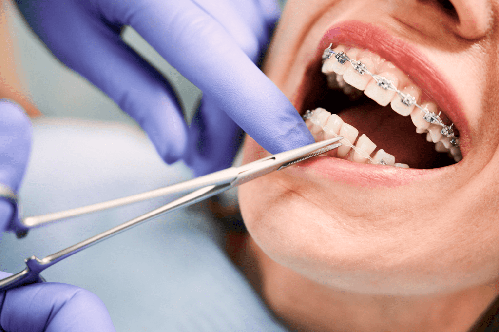 Clear Braces vs. Traditional Braces Lakeland family Dentistry in Flowood MS At Lakeland Family Dentistry, we receive many patients who desire to straighten their teeth through clear or traditional braces.